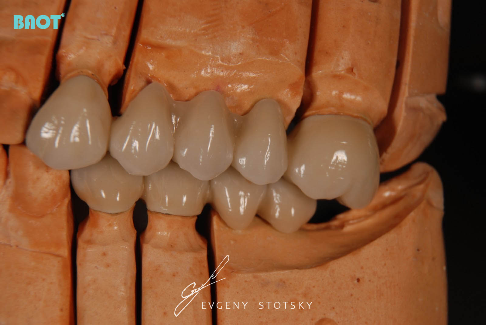 Utilisation de la céramique pour les prothèses dentaires